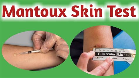 Mantoux test .
